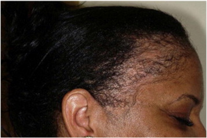 Patient with traction alopecia