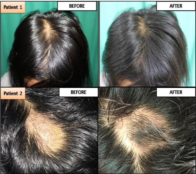 Patients with alopecia areata before and after treatment with tretinoin steroid cream