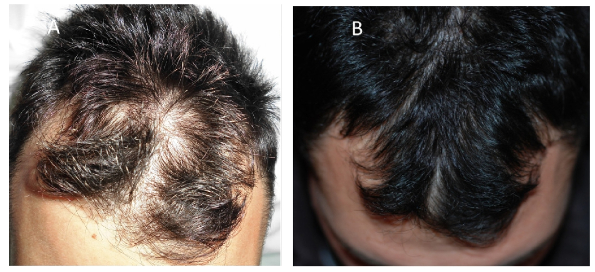 Preoperative situation of the scalp with hair loss before and after treatment