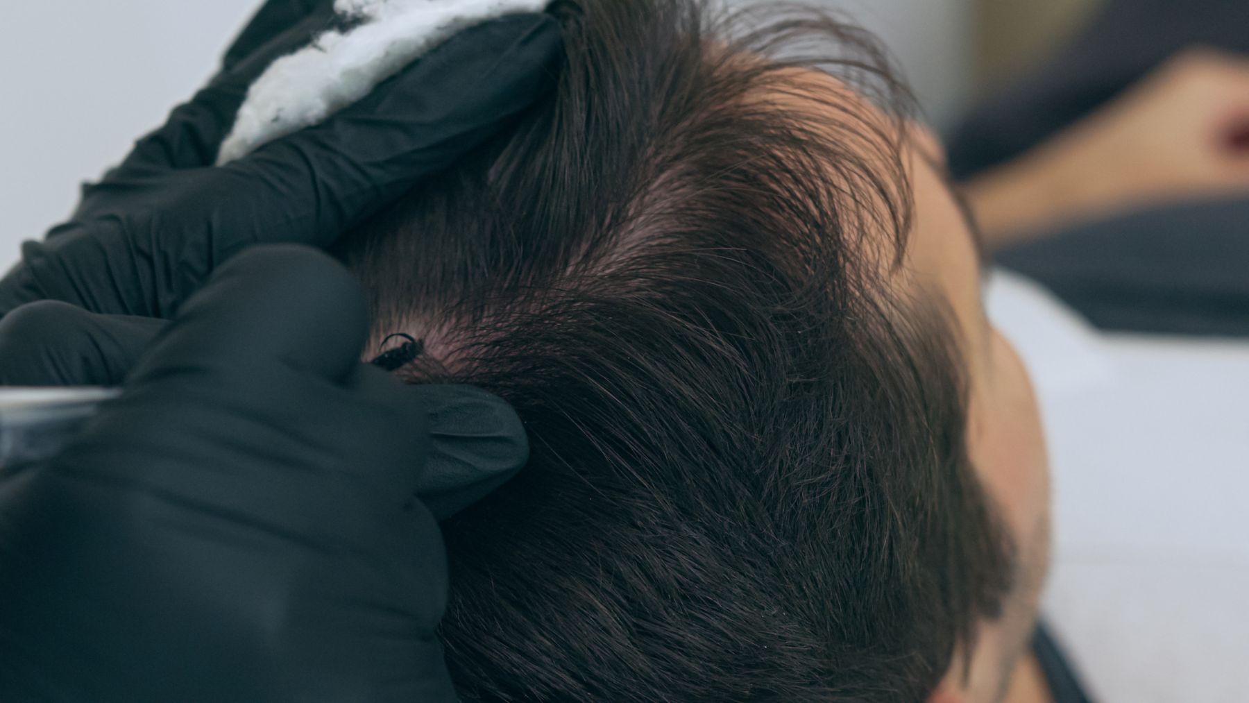 Scalp micropigmentation for men