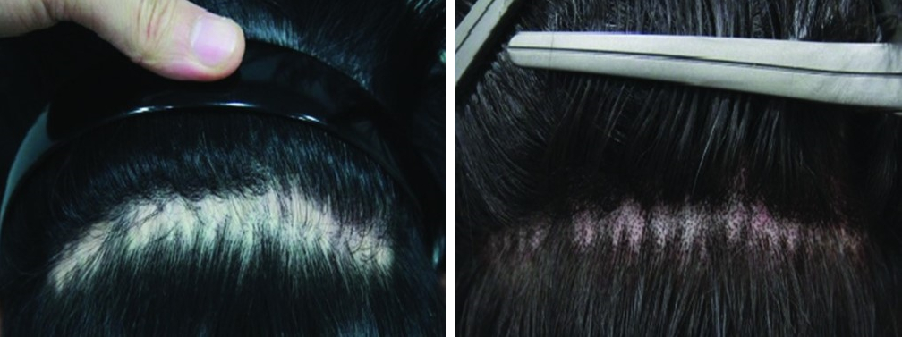 Scar from FUT transplant before and after scalp micropigmentation
