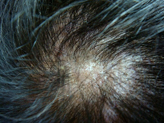 Scarring alopecia (lichen planopilaris)