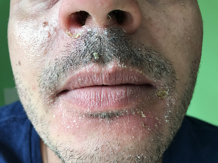 Seborrheic dermatitis of the beard