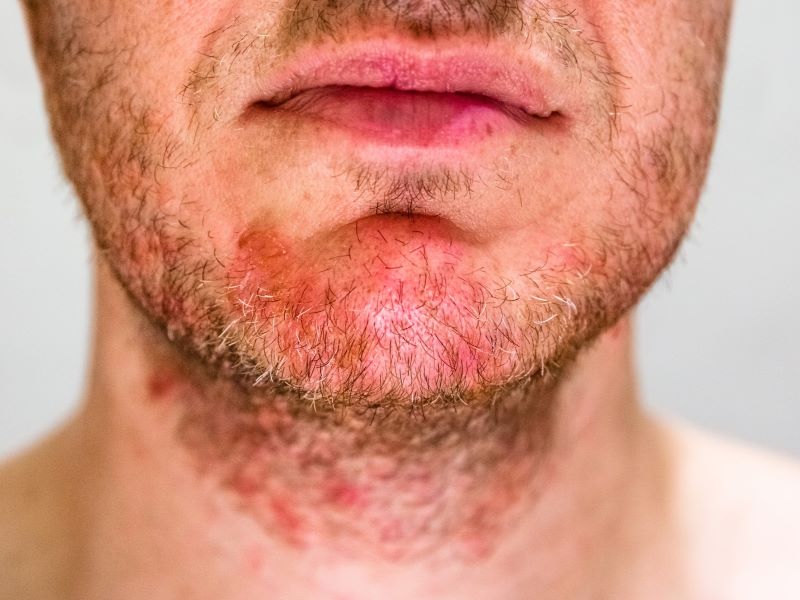 Seborrheic dermatitis on the beard