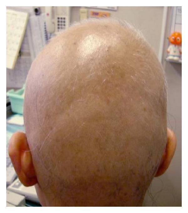 Severe Hair Loss of the Scalp due to a Hair Dye Containing Para phenylenediamine