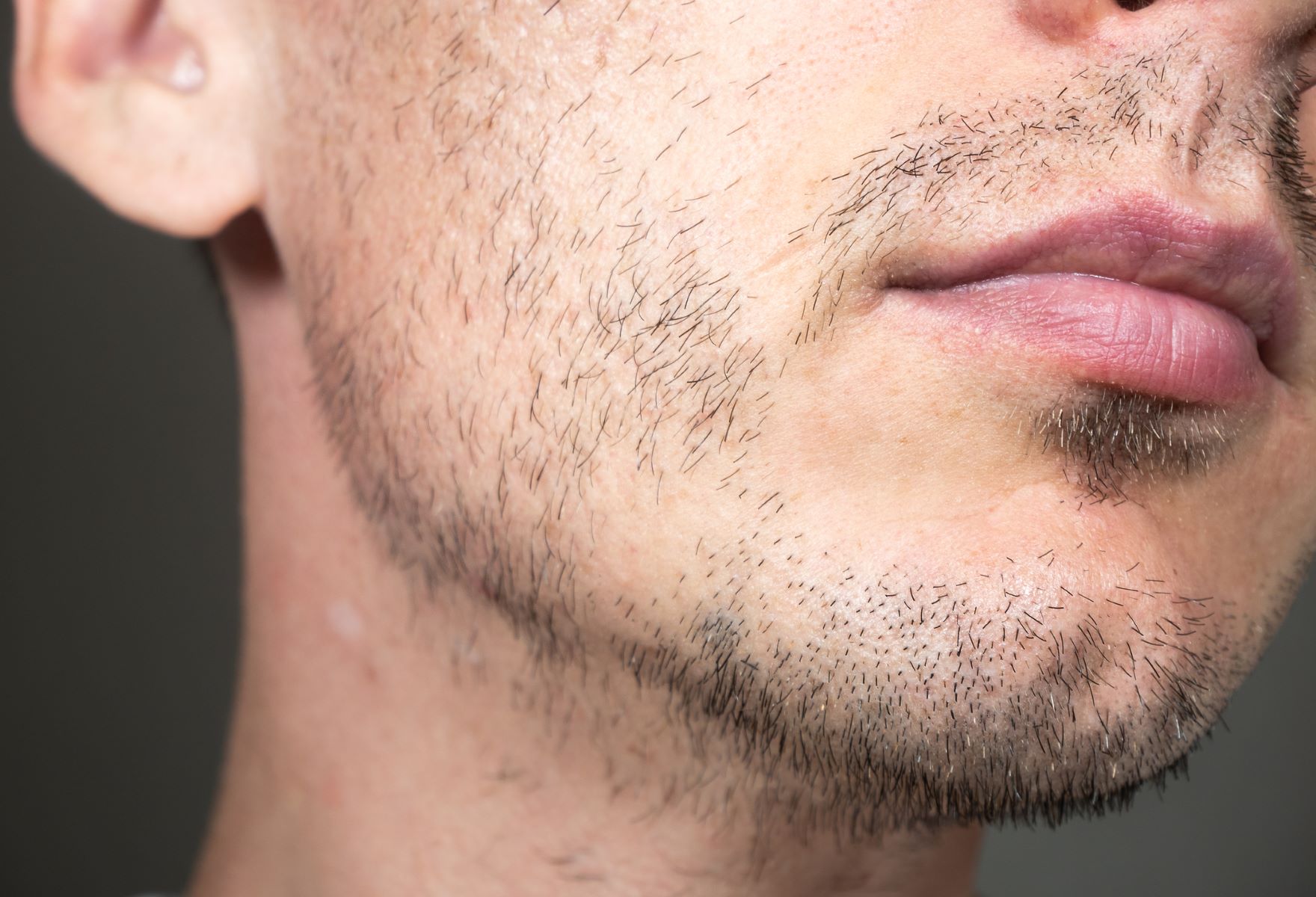 Sparse, uneven beard growth on a young man