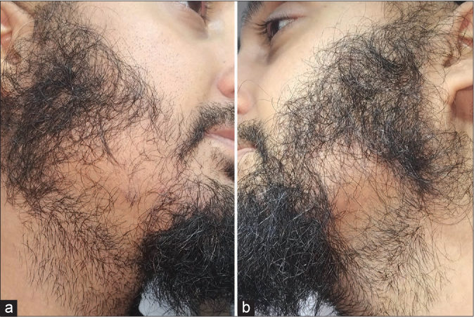 Two images taken from each side of a man with bilateral traction alopecia of the beard