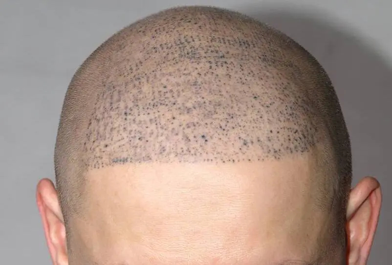 Unnatural micropigmentation results on a patient with shaved head