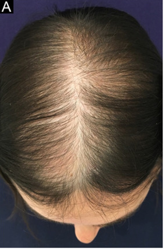 Woman with female pattern baldness