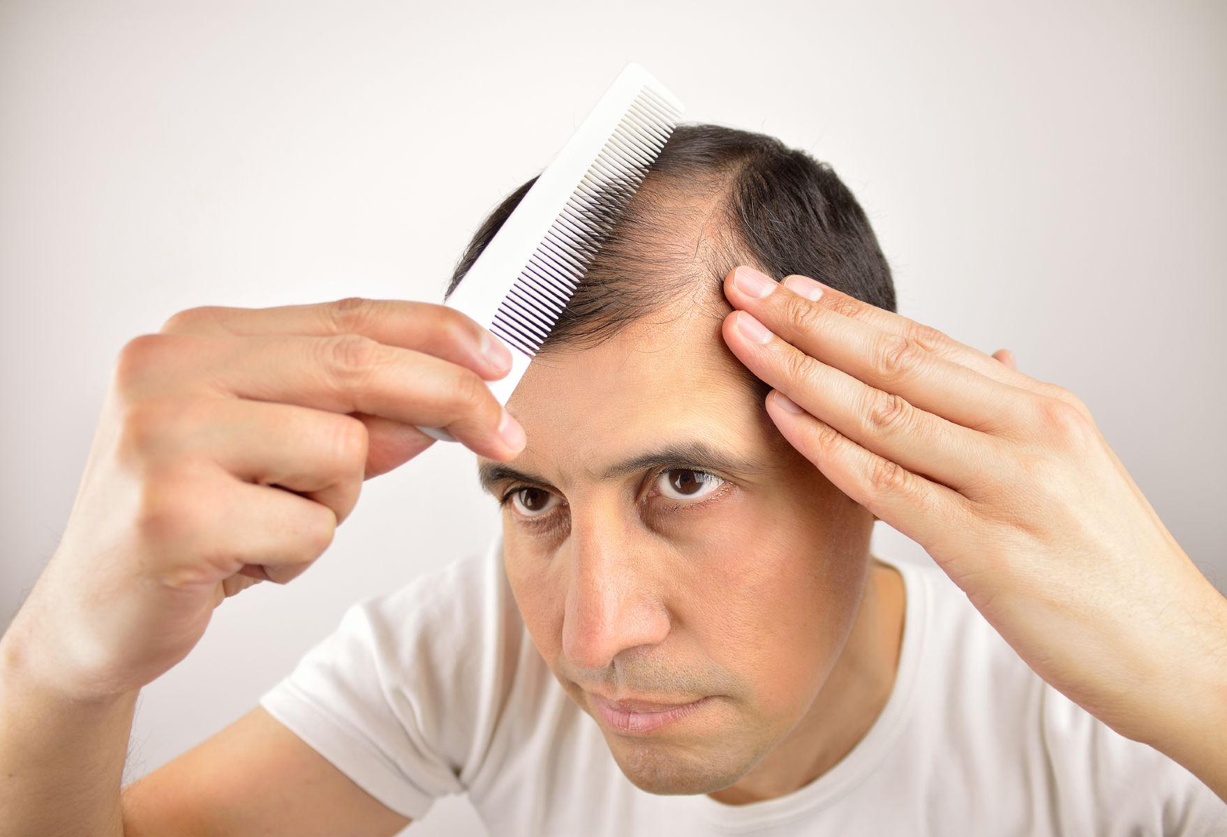 man combing hair over his bald spot