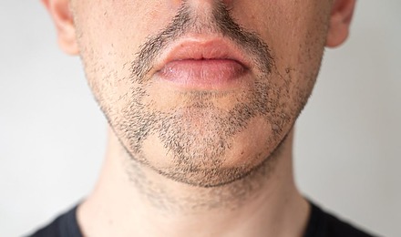 Patchy Beard