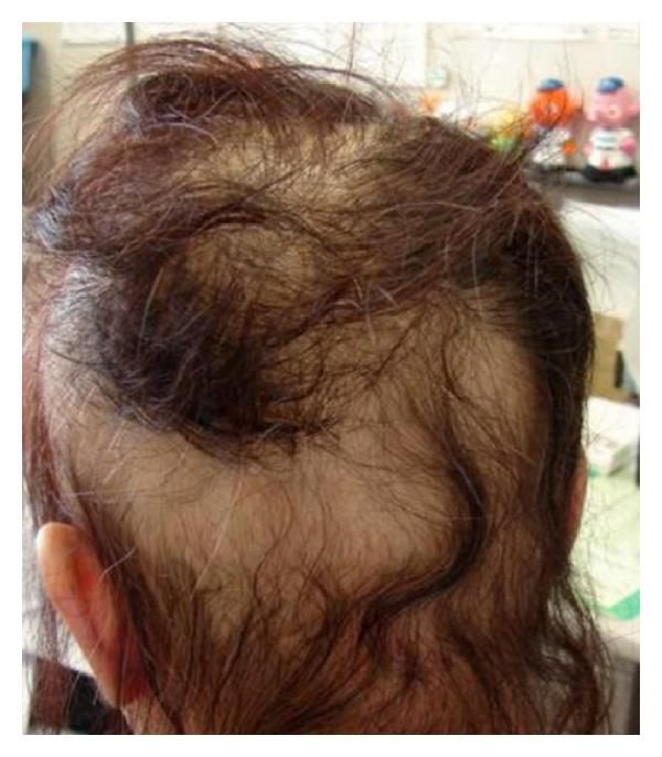 severe hair loss after applying hair dye that contained PPD