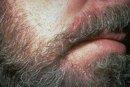 Beard seborrheic dermatitis