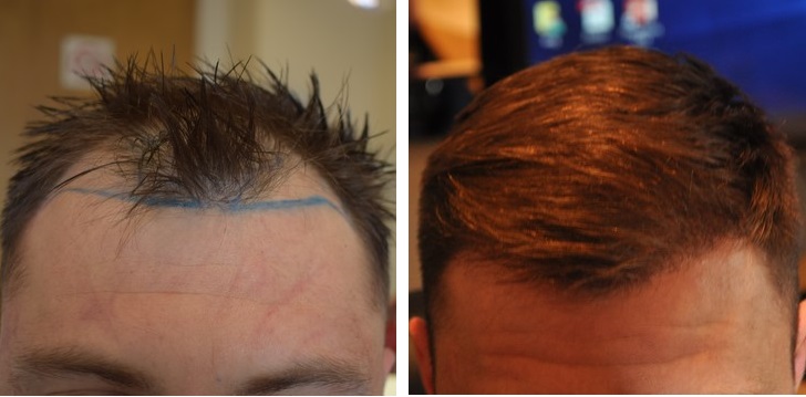 Before and after FUE hairline hair transplant