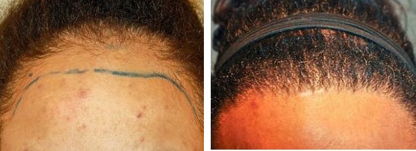 Before and after female afro hairline transplant