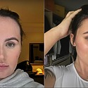 Beth Halsey’s Forehead Reduction: How It Changed Her Life