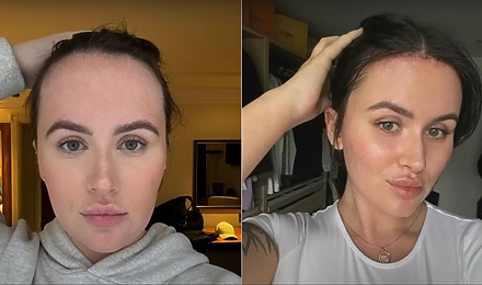 Beth Halsey’s Forehead Reduction: How It Changed Her Life