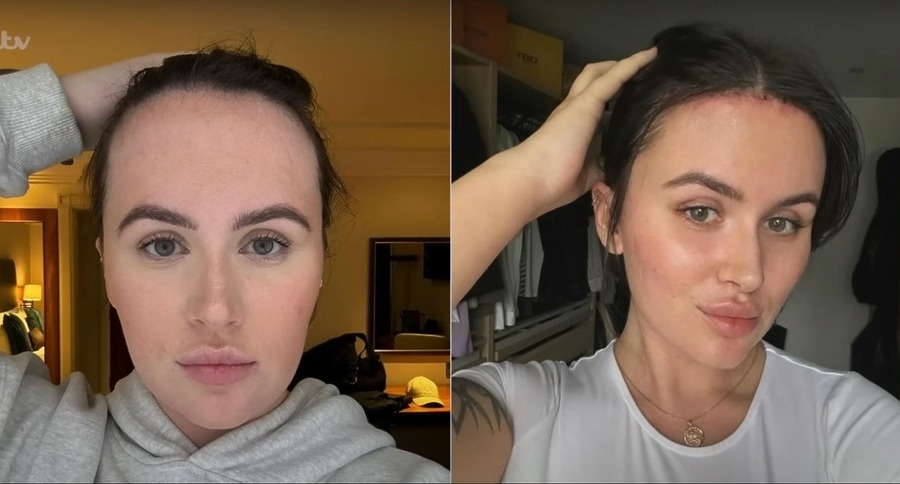 Beth Halsey’s Forehead Reduction: How It Changed Her Life