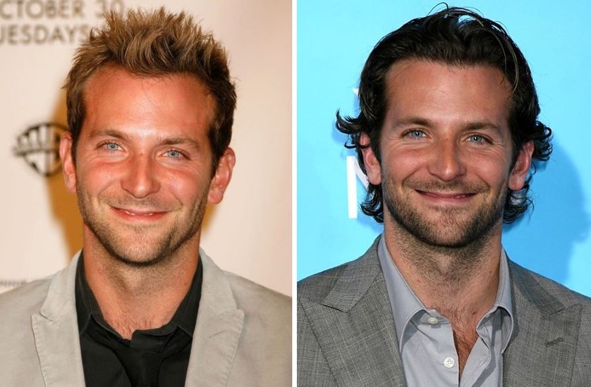 Bradley Cooper's Hair Transplant: Hollywood’s Best-Kept Secret