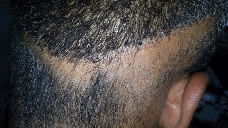 Donor area hair loss after hair transplant