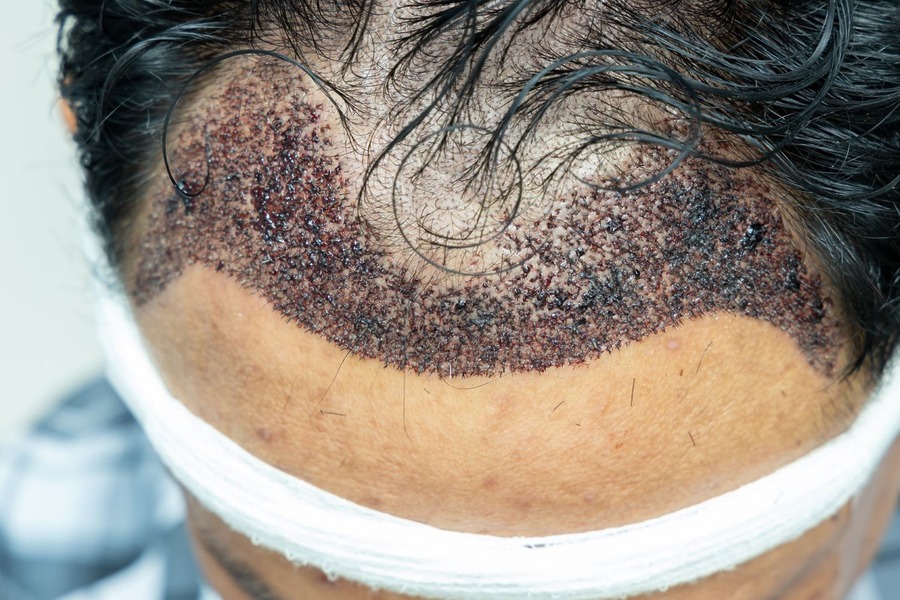 Hair Transplant Risks: Everything You Need To Know