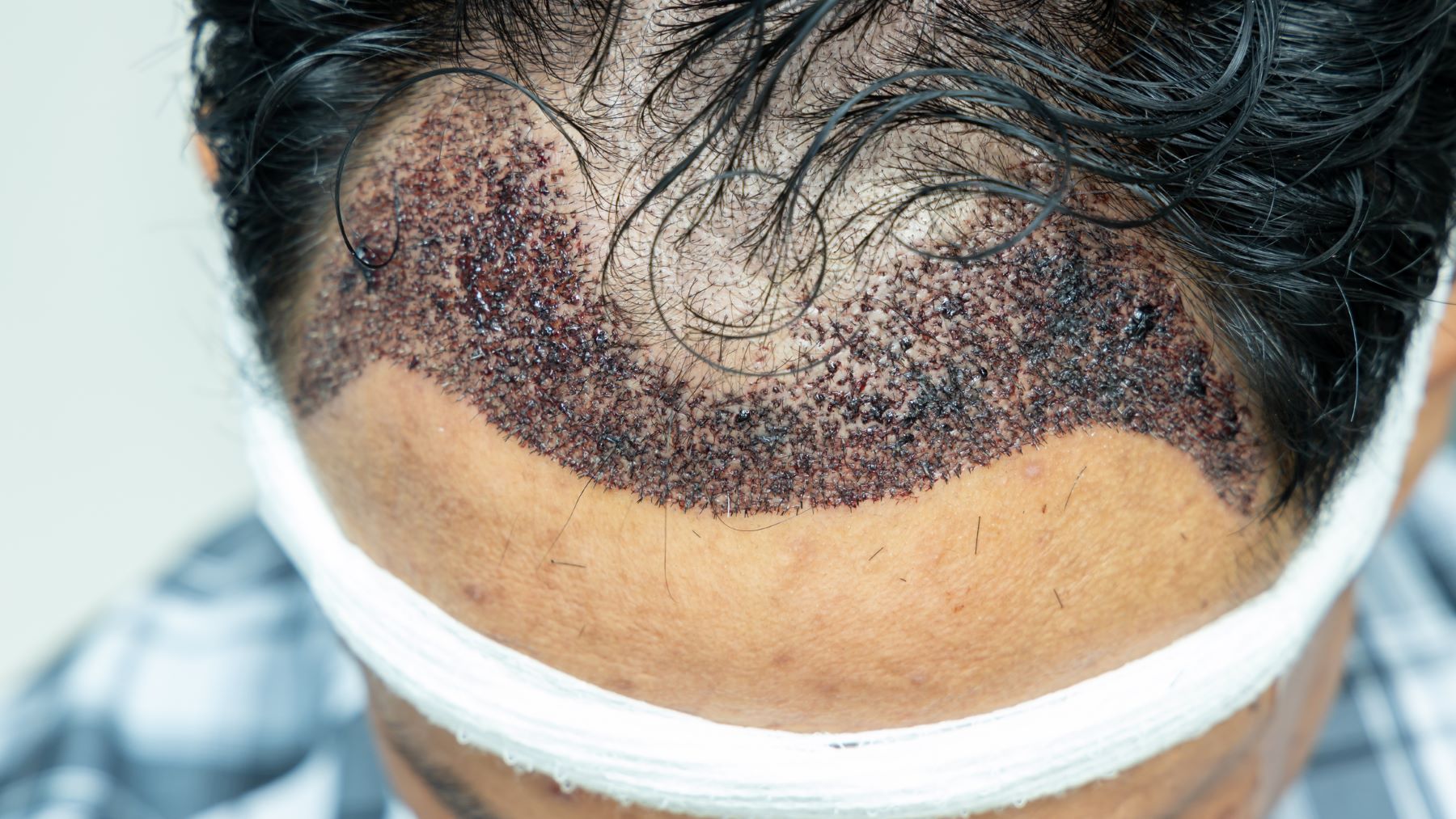 Hair Transplant Risks: Everything You Need To Know