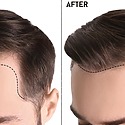 Hairline Transplant Surgery: Everything You Need To Know