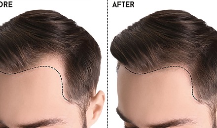 Hairline Transplant Surgery: Everything You Need To Know