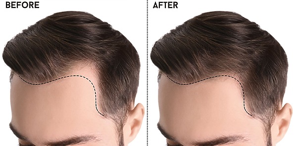 Hairline Transplant Surgery: Everything You Need To Know