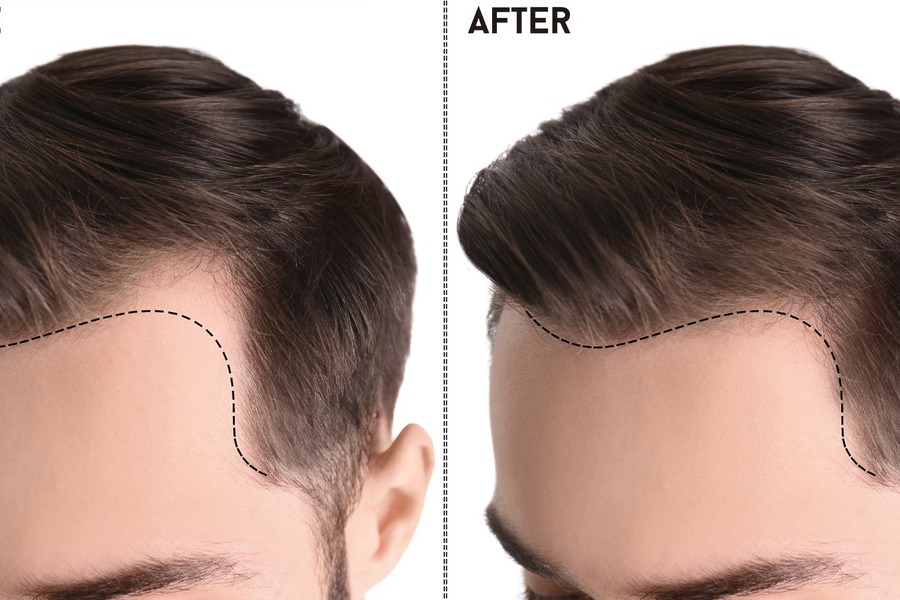 Hairline Transplant Surgery: Everything You Need To Know