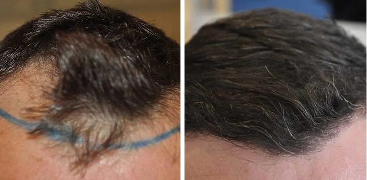 Hairline before and after hair transplant