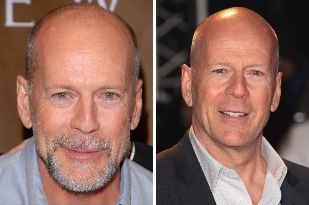 (L) Bruce Willis bald with beard ; (R) Bruce Willis bald without a beard