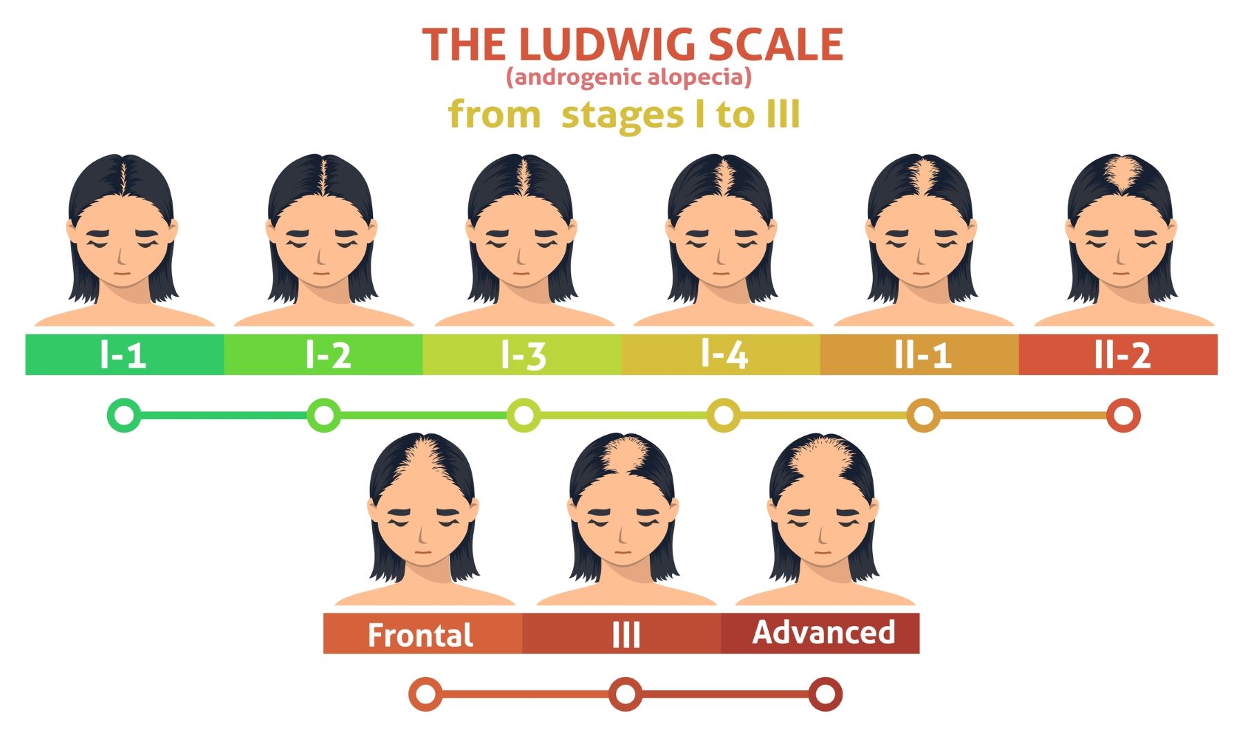 Ludwig scale androgenic alopecia step poster female balding