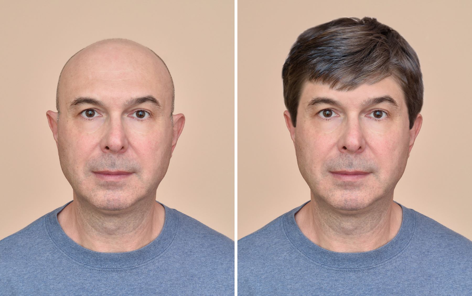 Man before and after wearing a hair system