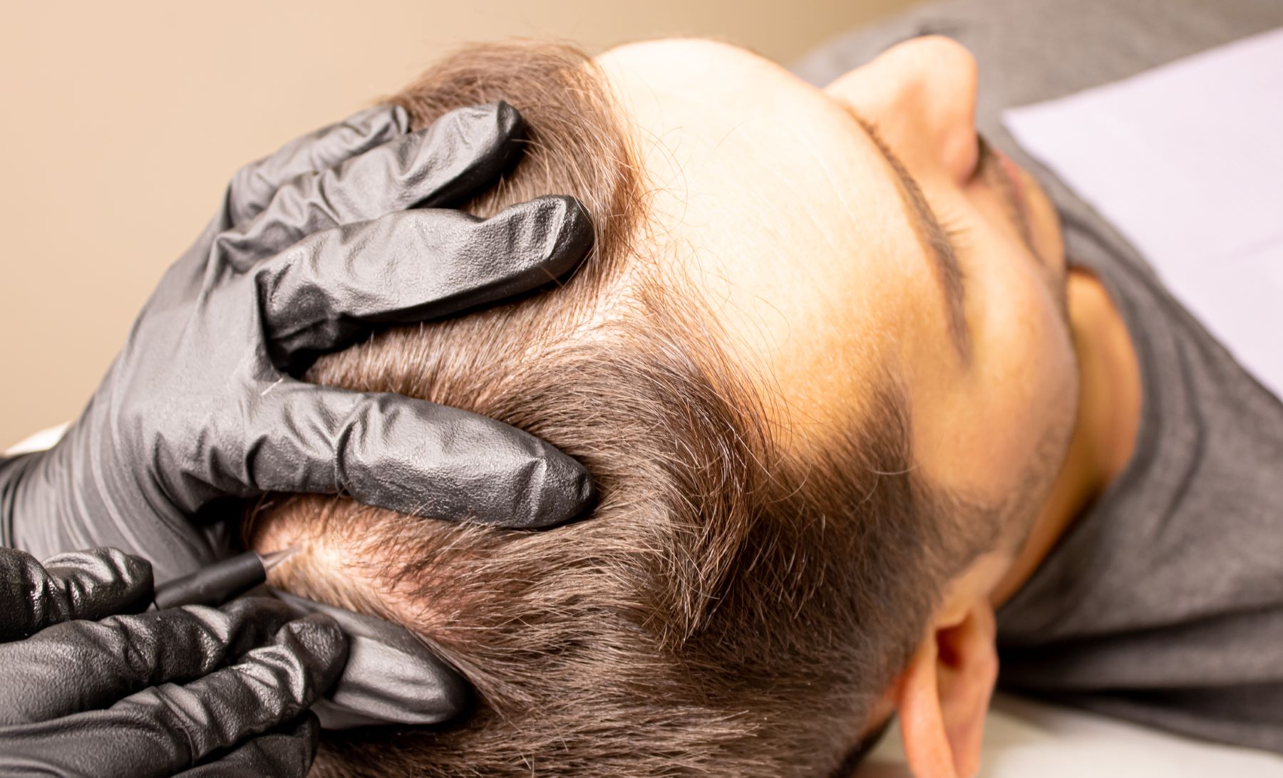Man getting scalp micropigmentation