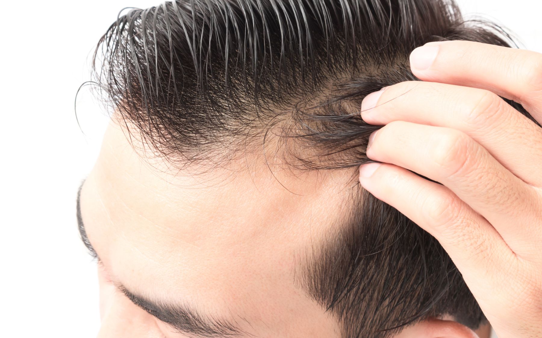 Man suspecting hair loss caused by his brow lift