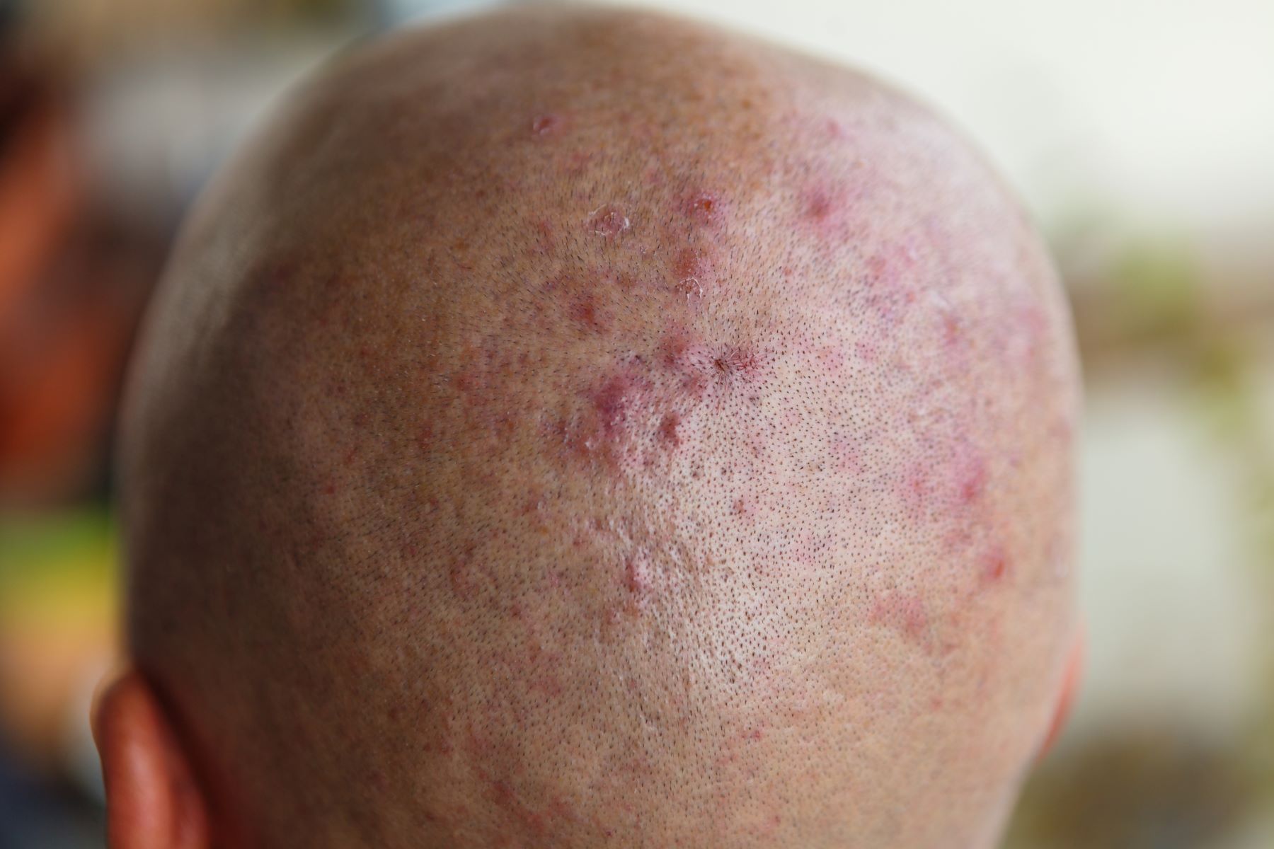 Man with a shaved head and scalp problems
