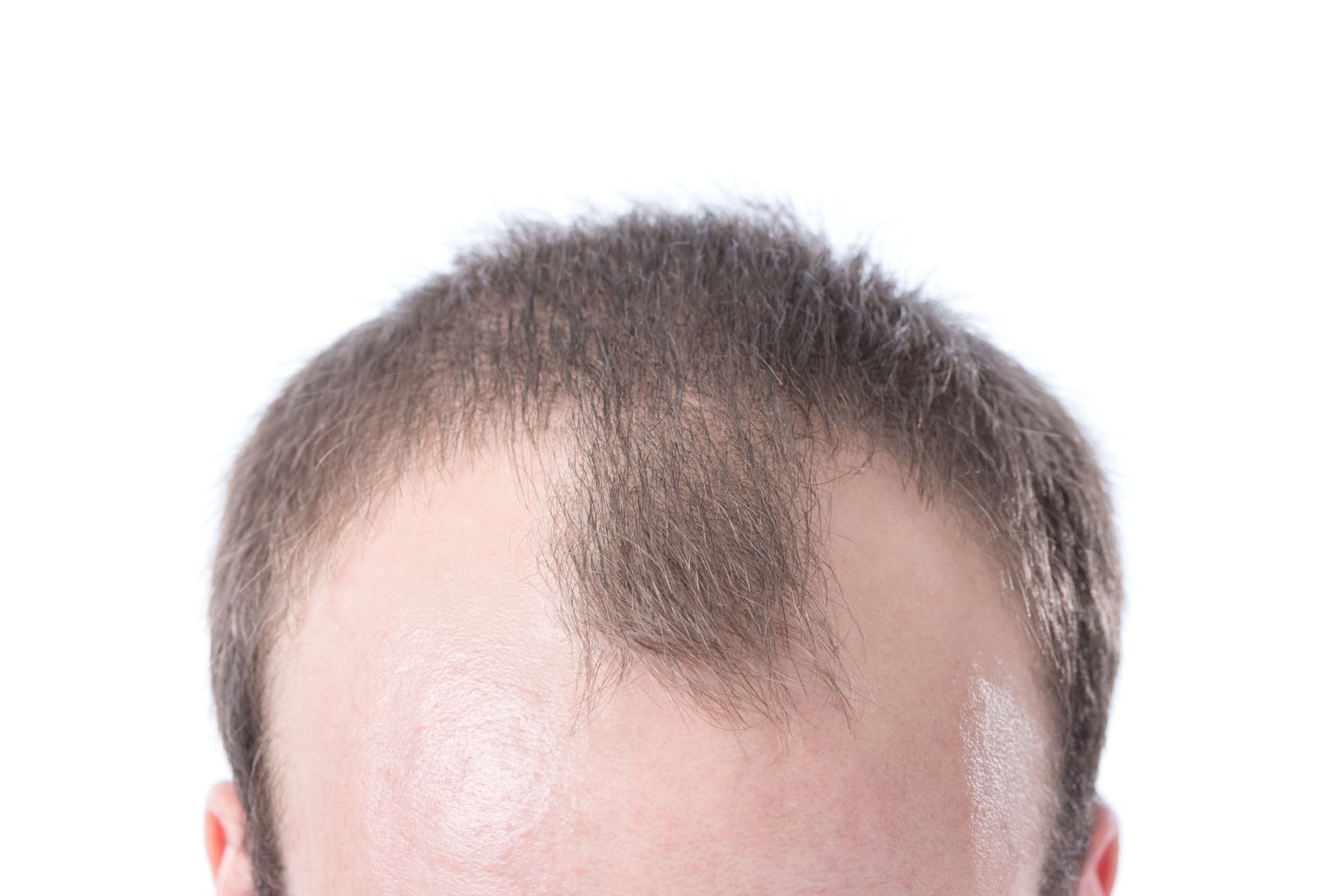 Man with male pattern baldness and receding hairline