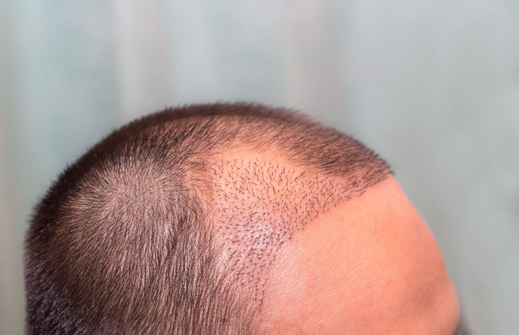 New hair growing after hairline transplant surgery