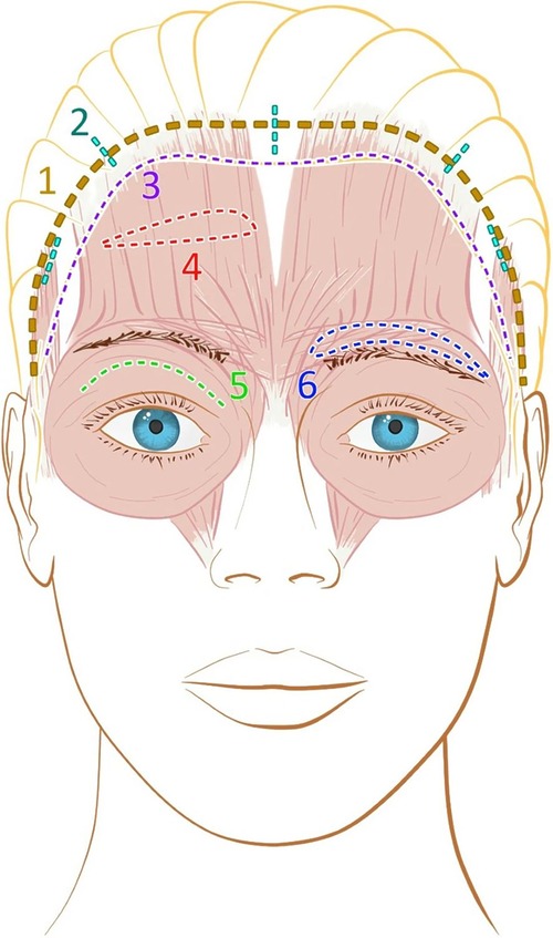 Overview of brow lift incision lines on a female face