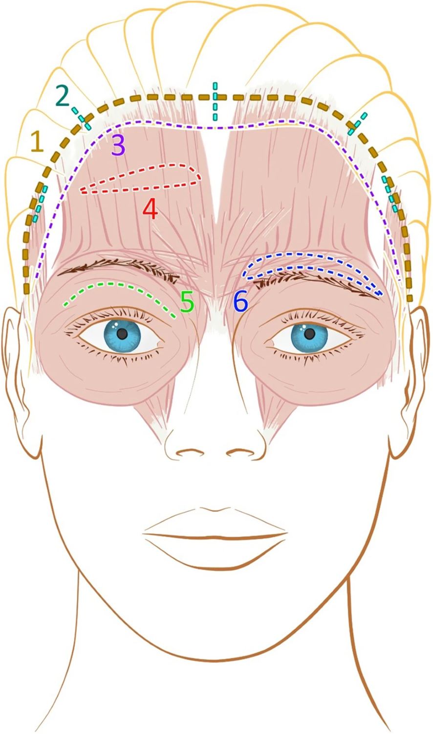 Overview of brow lift incision lines on a female face