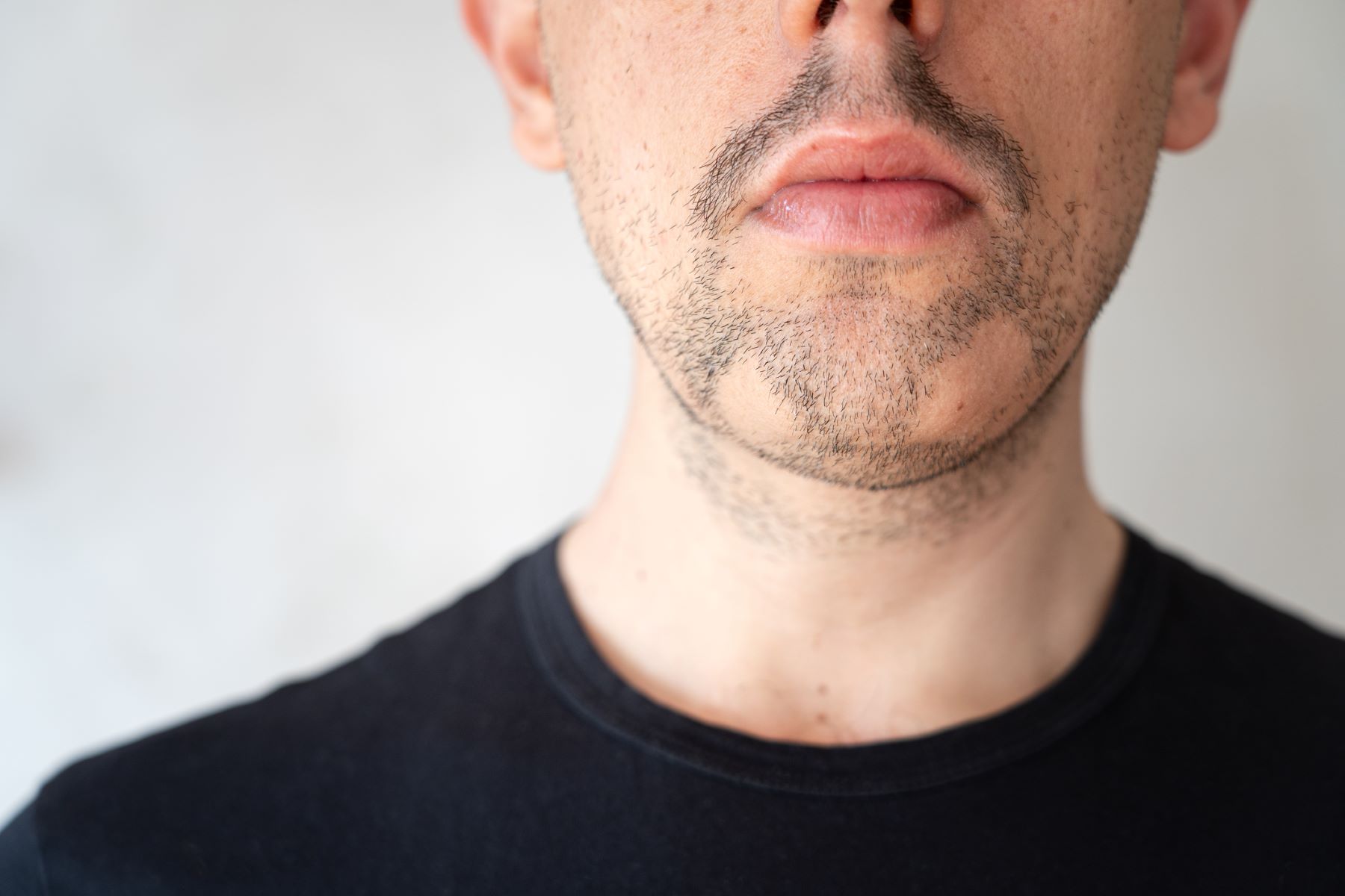 Patchy beard due to alopecia barbae
