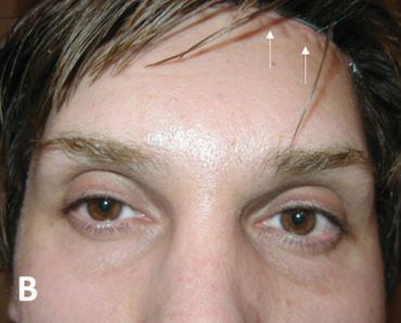 Patient with forehead scarring, a common brow lift risk