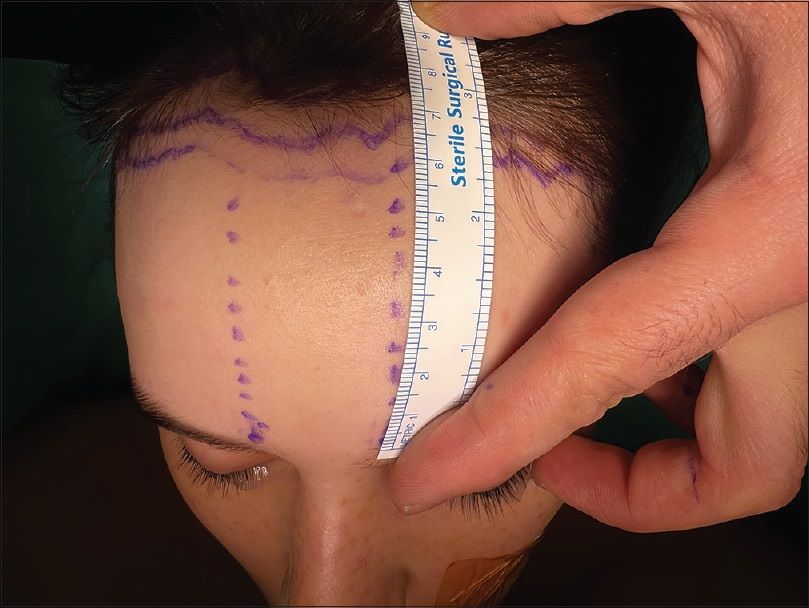 Preoperative planning for forehead reduction surgery