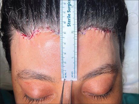 Results immediately after forehead reduction surgery