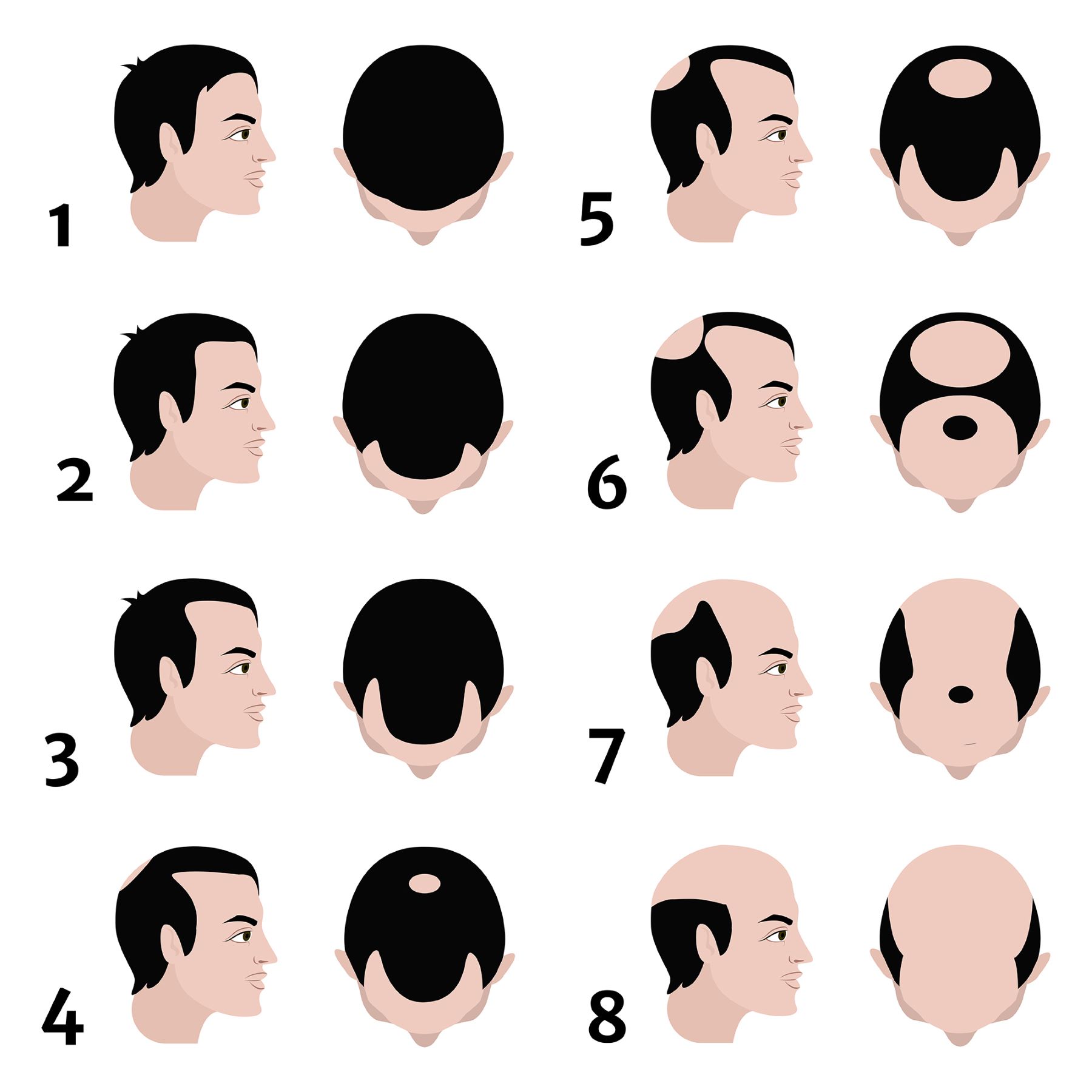 The Norwood Scale for male pattern baldness