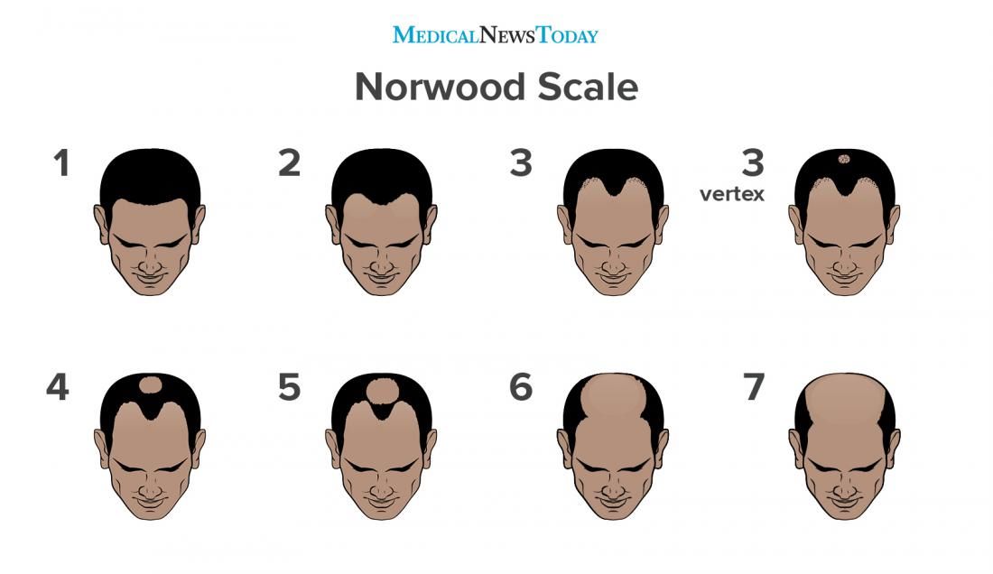 Norwood Scale for male pattern baldness