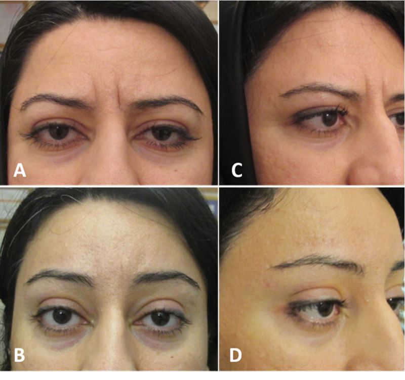 Woman before and 1 year after endoscopic brow lift