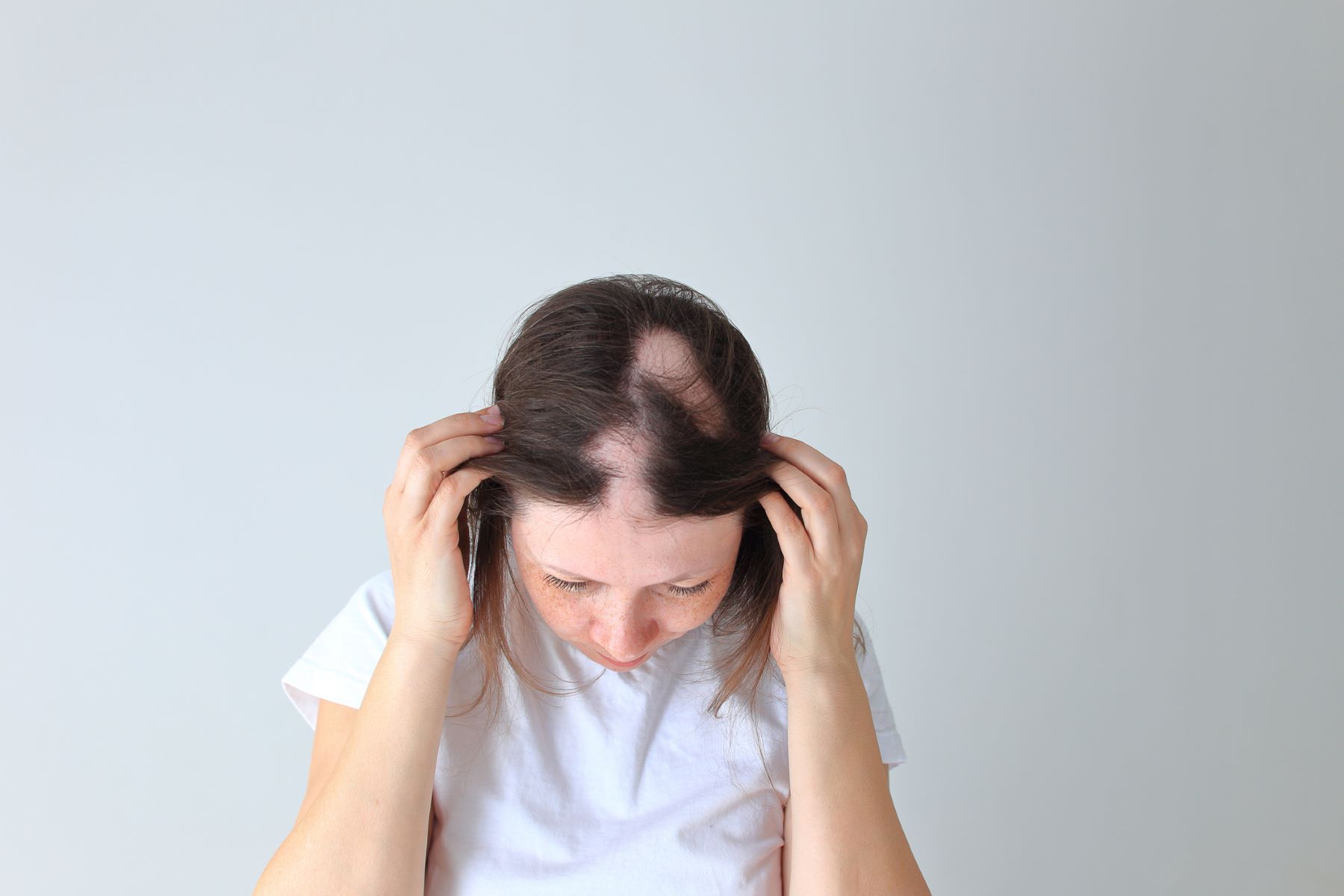 Woman with bald spots from alopecia areata