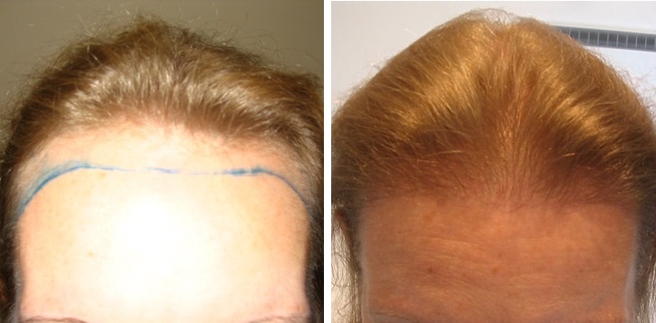 woman's hairline before and after 1800 FUT hair transplant